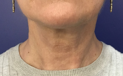 After-Neck