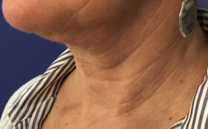 Neck Before