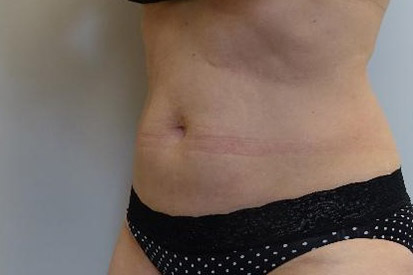 After-Before and 4 months after treatment with Coolsculpting