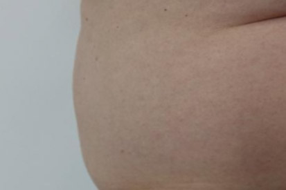 After-Before and 3 months after treatment with Coolsculpting