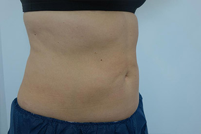 After-Before and 3 months after treatment with Coolsculpting