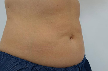 Before-Before and 3 months after treatment with Coolsculpting