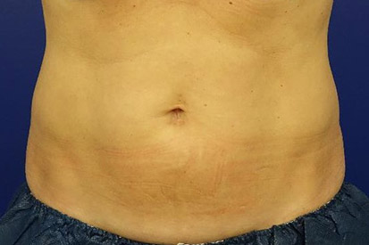 After-Before and 6 months after treatment with Coolsculpting