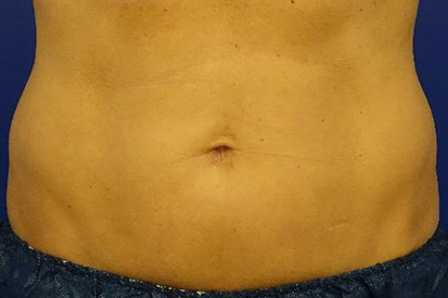 Before-Before and 6 months after treatment with Coolsculpting