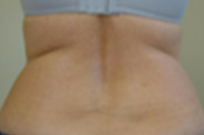 Before-Before and 9 months after treatment with Coolsculpting