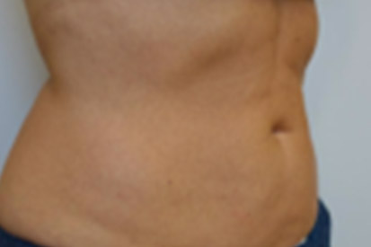 After-Before and 9 months after treatment with Coolsculpting