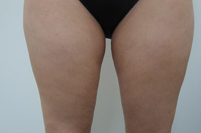 After-Before and 3 months after treatment with Coolscultping