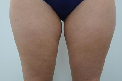 Before-Before and 3 months after treatment with Coolscultping