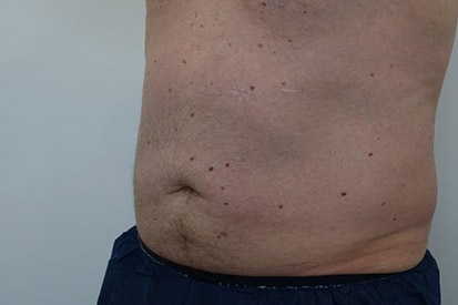 After-Before and 5 months after treatment with Coolsculpting