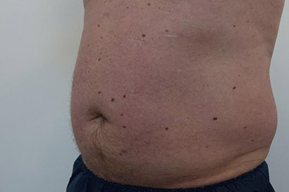 Before-Before and 5 months after treatment with Coolsculpting