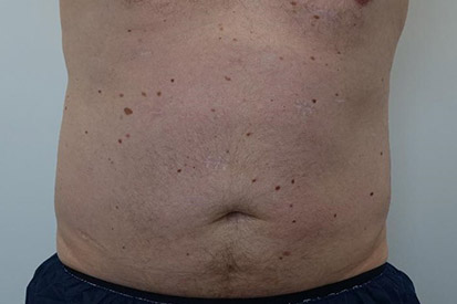 After-Before and 5 months after treatment with Coolsculpting