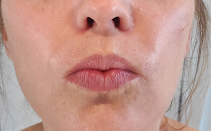 After-Botox Treatment For Lips