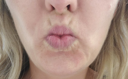 Before-Botox Treatment For Lips