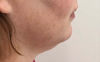 Before-Double Chin Treatment