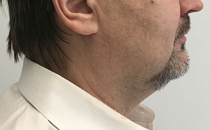After-Double Chin Treatment