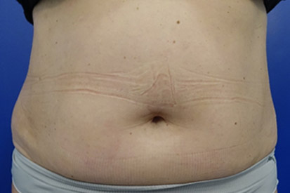 After-Flanks and lower abdo - 5 months post treatment - 10 cycles