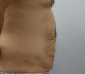 Male liposuction after