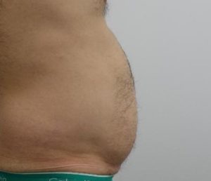 Male liposuction before