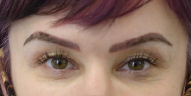 Before-Upper Eyelid