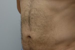 After Male Liposuction