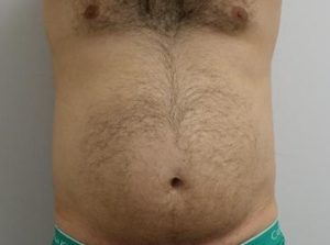 Before male liposuction