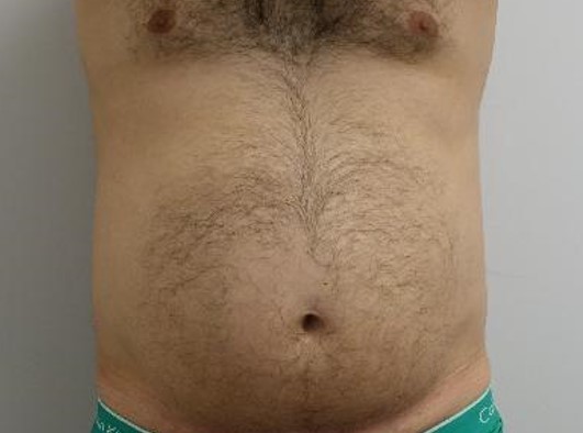 Before-Liposuction