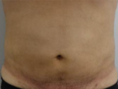 After-Liposuction