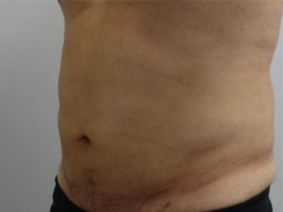 After-Male Liposuction