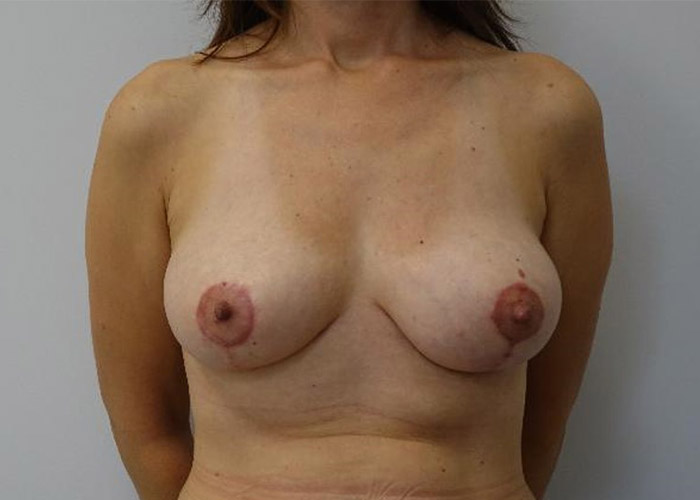 After-Breast Lift