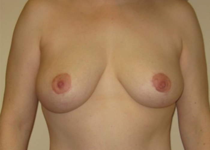 After-Breast Lift