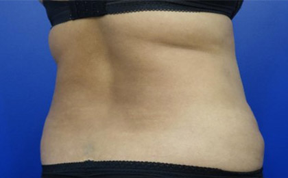Before-Liposuction 