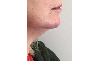 After-Filler and Botox 