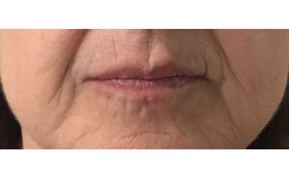 Before-Filler For Upper Lip Lines/perioral Lines