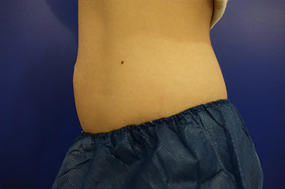 After-Right Abdominal area due to a hernia repair  2 cycles, 1 session.