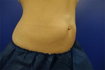 After-Right Abdominal area due to a hernia repair  2 cycles, 1 session.