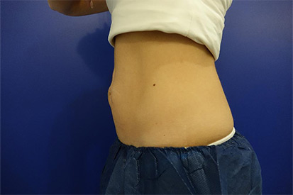 Before-Right Abdominal area due to a hernia repair  2 cycles, 1 session.