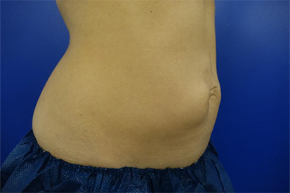 Before-Right Abdominal area due to a hernia repair  2 cycles, 1 session.
