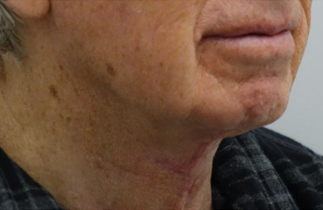 After-Direct Neck Lift 