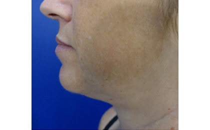 After-Double Chin CoolSculpting