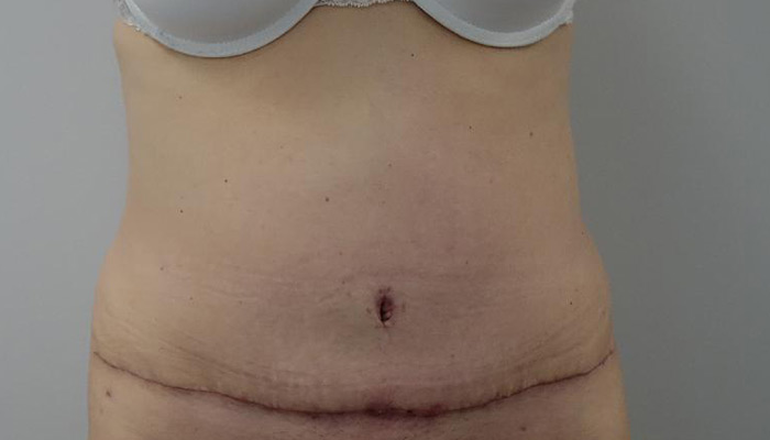 After-Tummy Tuck 