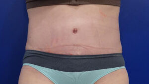 after tummy tuck