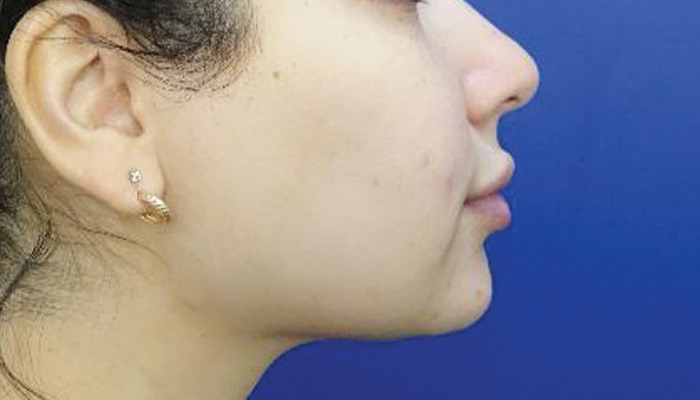 After-Chin Liposuction