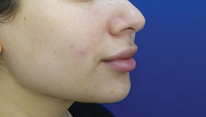 After-Chin Liposuction 