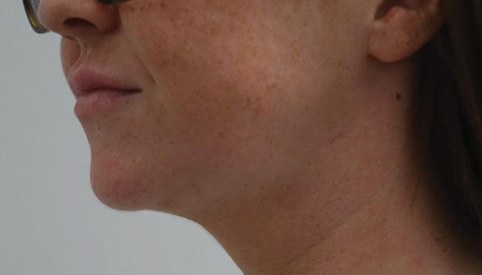 After-Chin Liposuction 