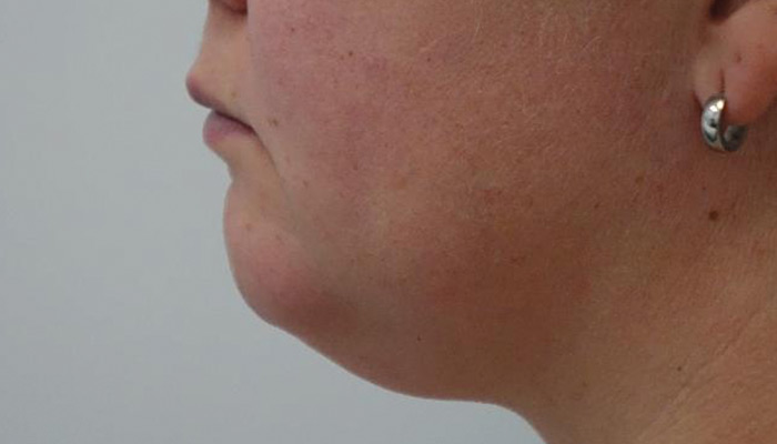 Before-Chin Liposuction 