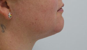 After Chin Liposuction
