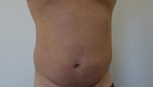 Before Male Liposuction