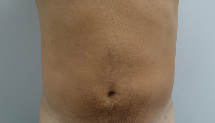 After-Male Liposuction