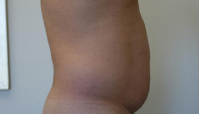 Before-Male Liposuction