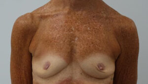 Before Breast Implants